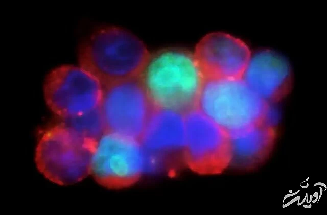 نتایج یک پژوهش: سرطان پستان هنگام خواب شبانه در بدن پیشروی میکند